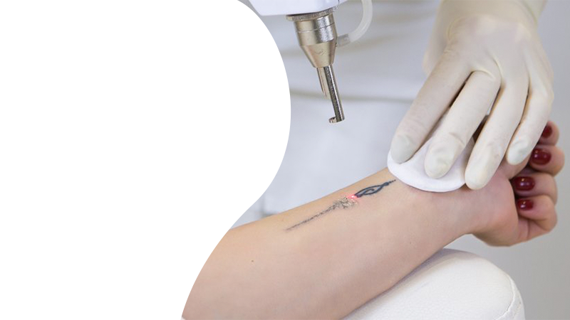 Метод лазерного выведения татуировок используется сравнительно недавно